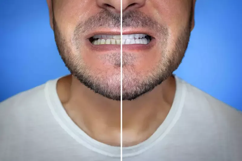 Antes e depois de reabilitação oral na Daldegan Odontologia, Niterói