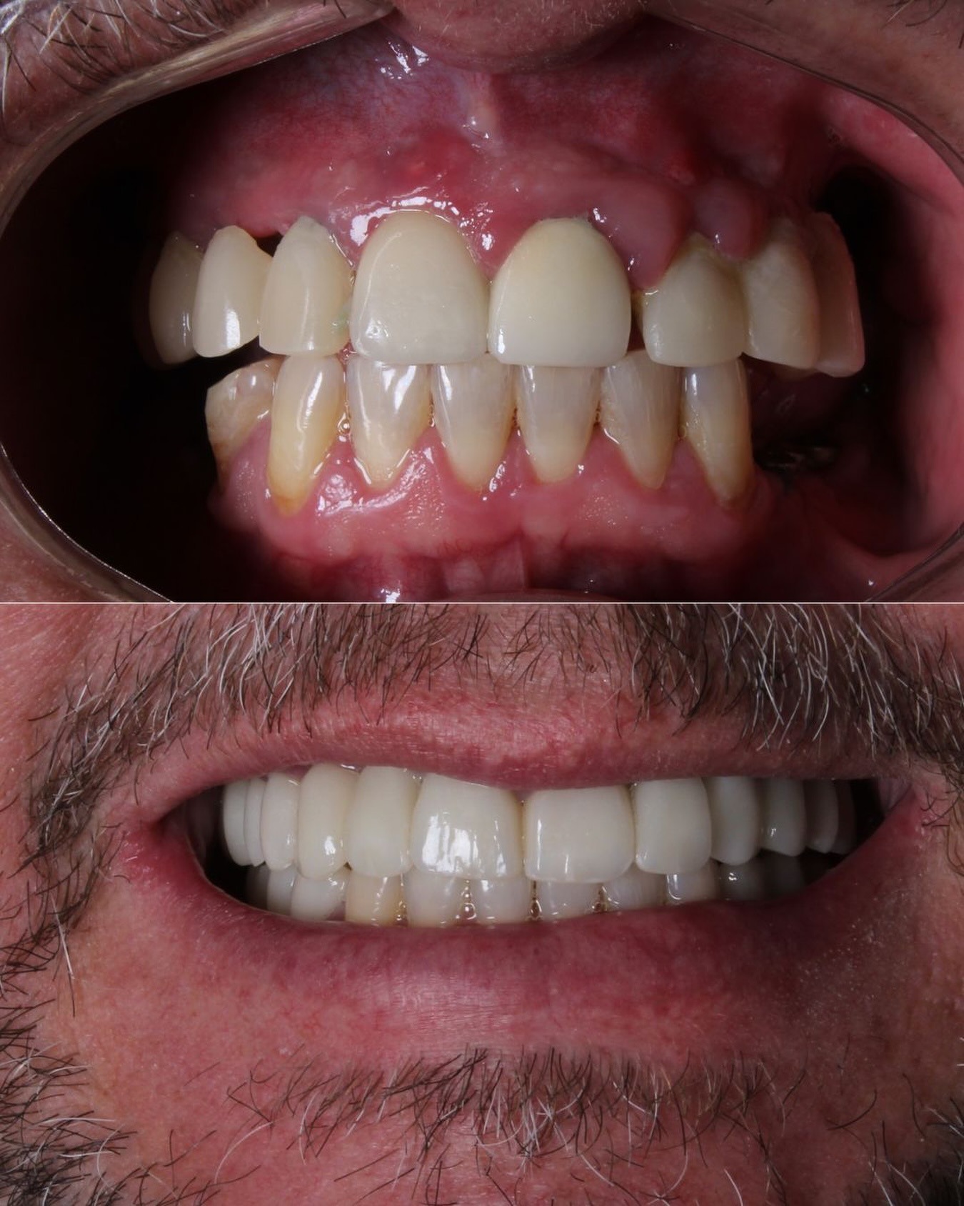 Resultado de clareamento dental Daldegan Odontologia Niteroi